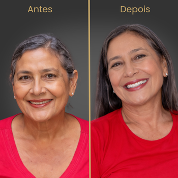 Resultado antes e depois de prótese protocolo sobre implantes dentários realizado na clínica Oral Fácil Prime em Irecê BA