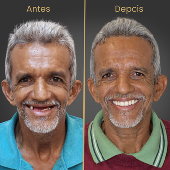 Resultado antes e depois de prótese protocolo sobre implantes dentários realizado na clínica Oral Fácil Prime em Irecê BA