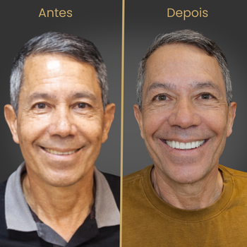 Resultado antes e depois de prótese protocolo sobre implantes dentários realizado na clínica Oral Fácil Prime em Irecê BA