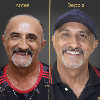 Resultado antes e depois de prótese protocolo sobre implantes dentários realizado na clínica Oral Fácil Prime em Irecê BA