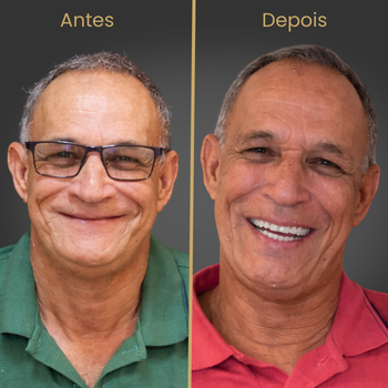 Resultado antes e depois de prótese protocolo sobre implantes dentários realizado na clínica Oral Fácil Prime em Irecê BA